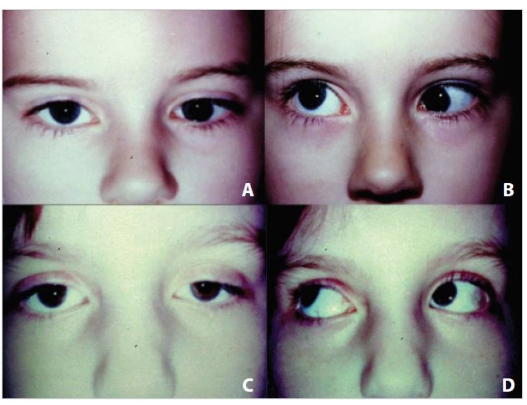 &lt;b&gt;Léčba expanderem&lt;/b&gt;: A – primární hypotropie vlevo ve třech letech, B – syndrom „cvaknutí“ v addukci vlevo před operací, C – vyrovnané postavení očí v pěti letech s konsekutivní semiptózou vlevo, D – prakticky vyrovnaná elevace v addukci vlevo