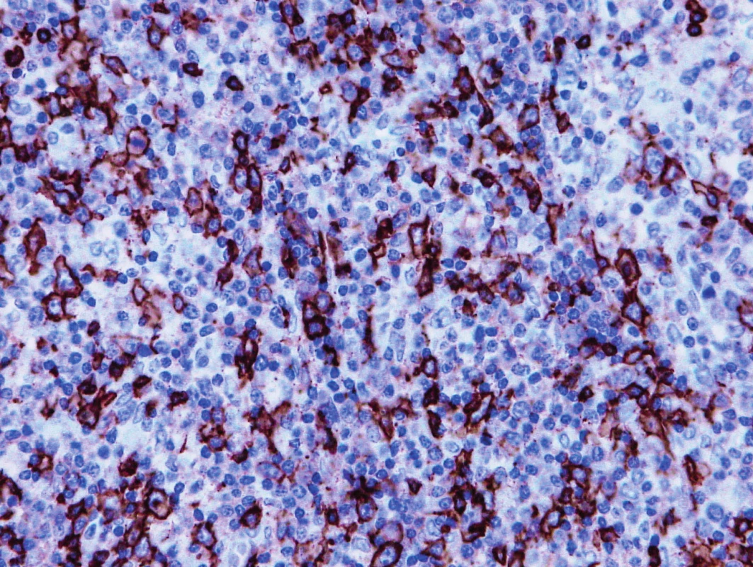 Vzorek z 1. bioptického odběru z roku 2013 – AITL 
CD20 pozitivita hojných disperzních velkých nenádorových B-buněk v příměsi nádorové buňky jsou negativní.