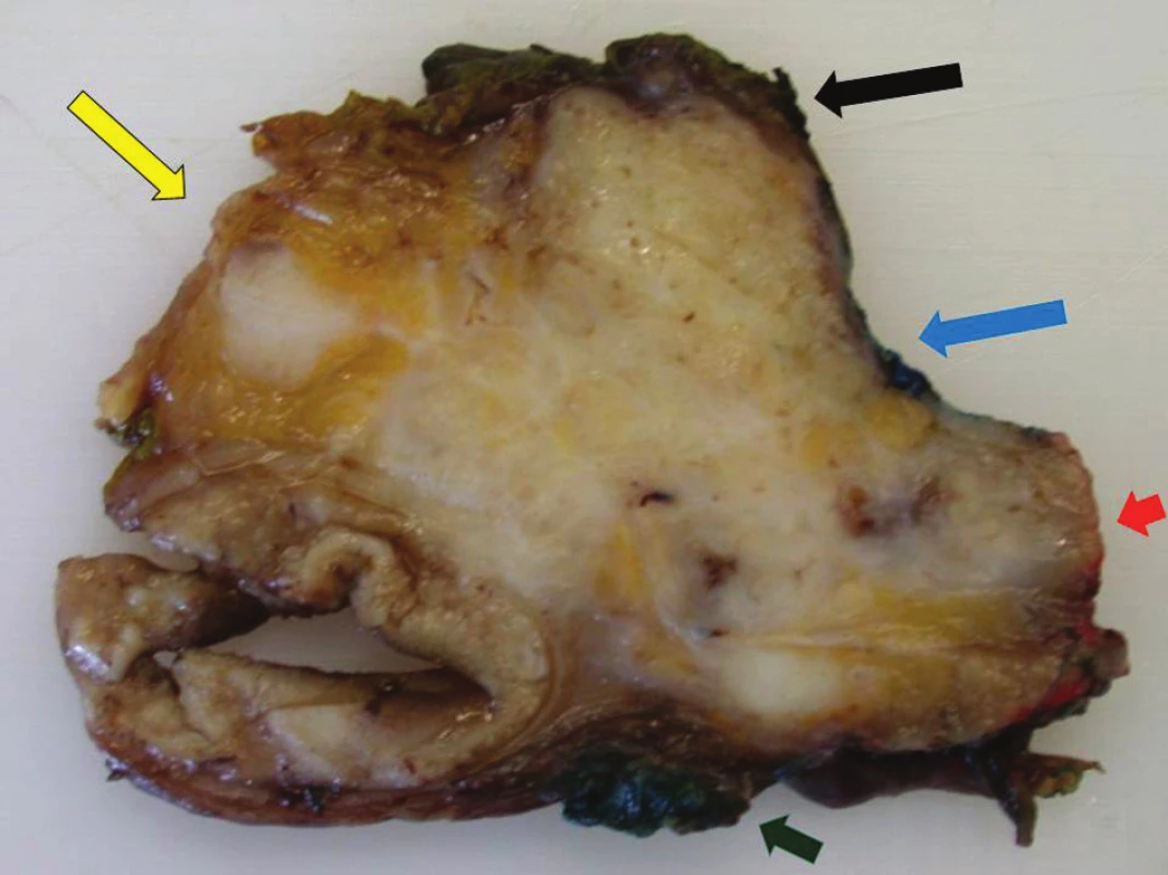Transverzální řez obarveným resekátem pankreatu s duktálním karcinomem
Černá šipka – transekční linie krčku pankreatu, modrá šipka – linie VMS, červená šipka – linie AMS, zelená šipka – dorzální linie, žlutá šipka – ventrální linie.
Fig. 2: Transverse section through the stained specimen of pancreatic cancer (ductal carcinoma)
Black arrow – cervical pancreas transection line, blue arrow – VMS line, red arrow – AMS line, green arrow – dorsal line, yellow arrow – ventral line.