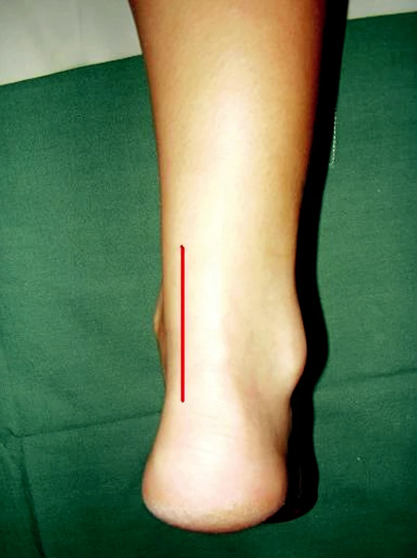 Posteromediální přístup k ruptuře Achillovy šlachy
Pic. 1. Posteromedial approach in a case of Achilles tendon rupture