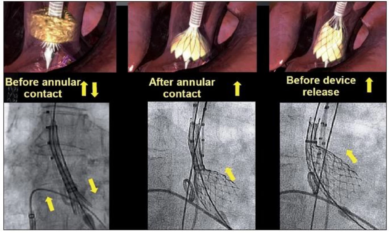 Schéma postupného uvolňování chlopně ze zaváděcího pouzdra do aortální pozice