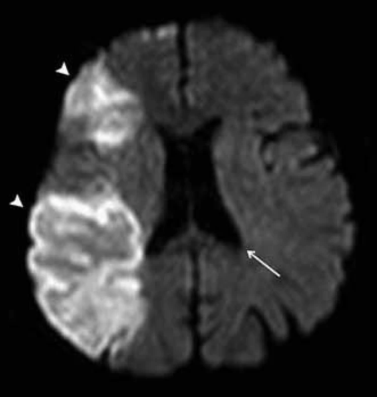DWI zobrazení mozku u pacienta s čerstvou ischemií v povodí a. cerebri media vpravo.