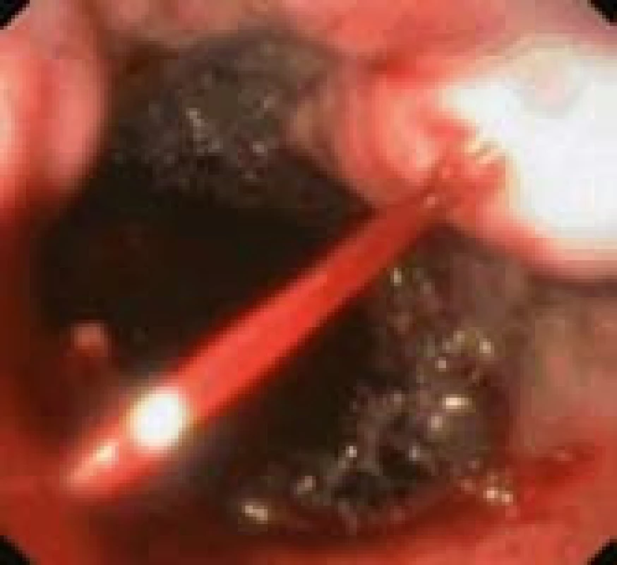 Akutní krvácení z varixu jícnu (nemocný s jaterní cirhózou).
Fig. 1. Acute bleeding from oesophageal varix (patient with liver cirrhosis).