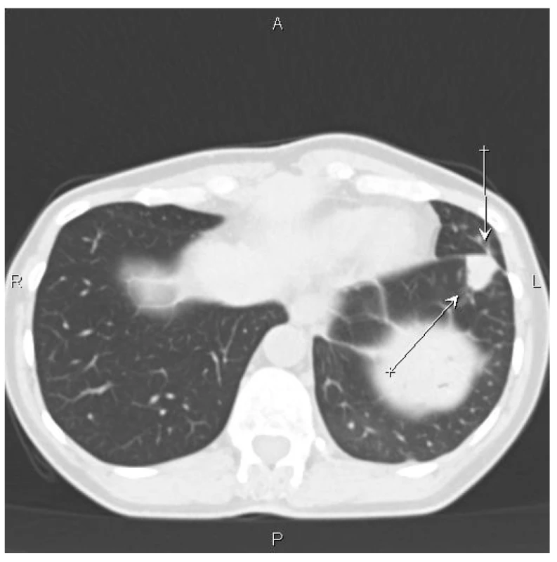 CT nález – šipky označují ložisko v levé plíci<br>
Fig. 3: CT scan – arrows indicate the focus in the left lung