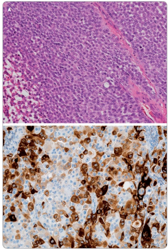 A. Morfologicky relativně homogenní populace epiteloidních elementů nodulárního melanomu. Je patrná vysoká mitotická aktivita v nádoru (hematoxylin-eosin; 100×). B. Tentýž nádor v imunohistochemickém průkazu S100 proteinu. Různý stupeň exprese (různá intenzita hnědé barvy) ukazuje na různý stupeň diferenciace nádorových buněk. Morfologická uniformita je tak pouze zdánlivá, nádorová populace je ve skutečnosti velice heterogenní (IHC S100 protein: DAB-hematoxylin; 200×).