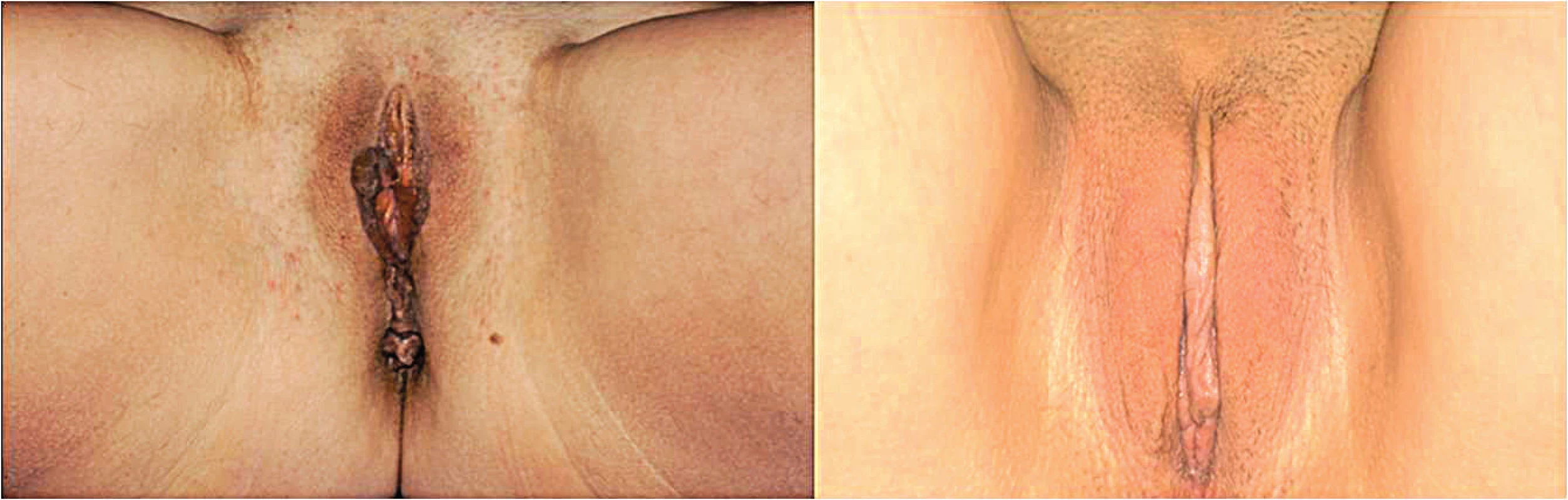 (Left) Preoperative view in a 31 years old patient. (Right) Post-operative view at 12 months