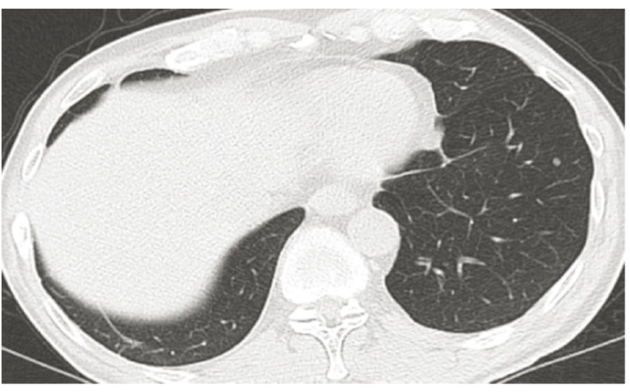 Progrese onemocnění –
drobná ložiska v levém plicním křídle
