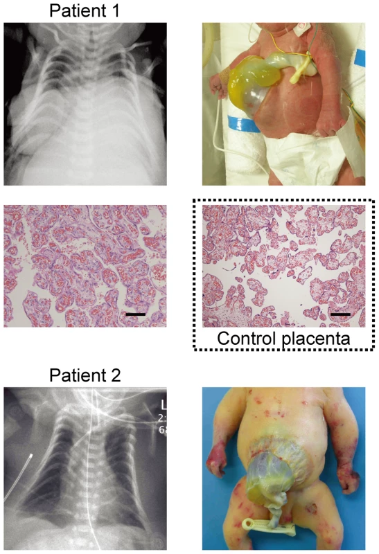 Clinical phenotypes of patients 1 and 2 at birth.