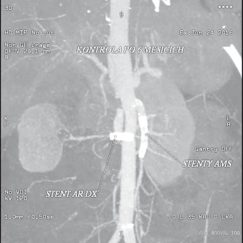 Kontrolní CT angiografie po šesti měsících od zákroku. Průchodné stenty v horní mezenterické tepně i pravé ledvinné tepně. Je patrná atrofie pravé ledviny, která je důsledkem ztráty funkce v rámci ischemie proběhlé během disekce.