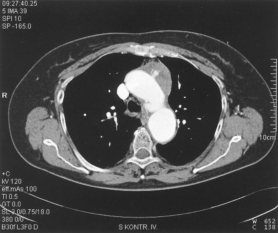 Pseudoaneurysms of the aortic arch
Obr. 1. Pseudoaneurysma oblouku aorty