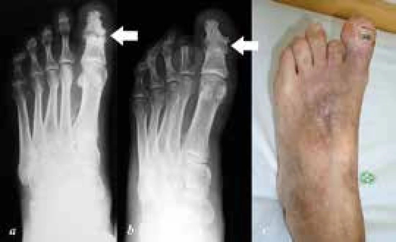 a: předoperační dorzoplantární RTG nohy s patrnou destrukcí IP kloubu palce při purulentní artritidě (šipka), dále gangréna distálního článku II. prstce;
b: pooperační dorzoplantární RTG nohy, stav po amputaci v základním článku II. prstce a artrodéze IP kloubu palce, artrodéza zhojená (šipka);
c: klinický snímek po operaci, zachování alespoň části II. prstce je nezbytné k zabránění valgizace palce