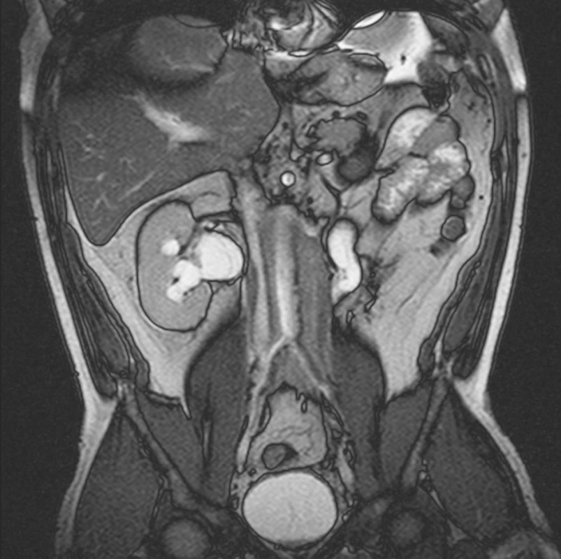 MRI prokazuje oboustrannou dilataci dutého systému obou ledvin a obou ureterů.