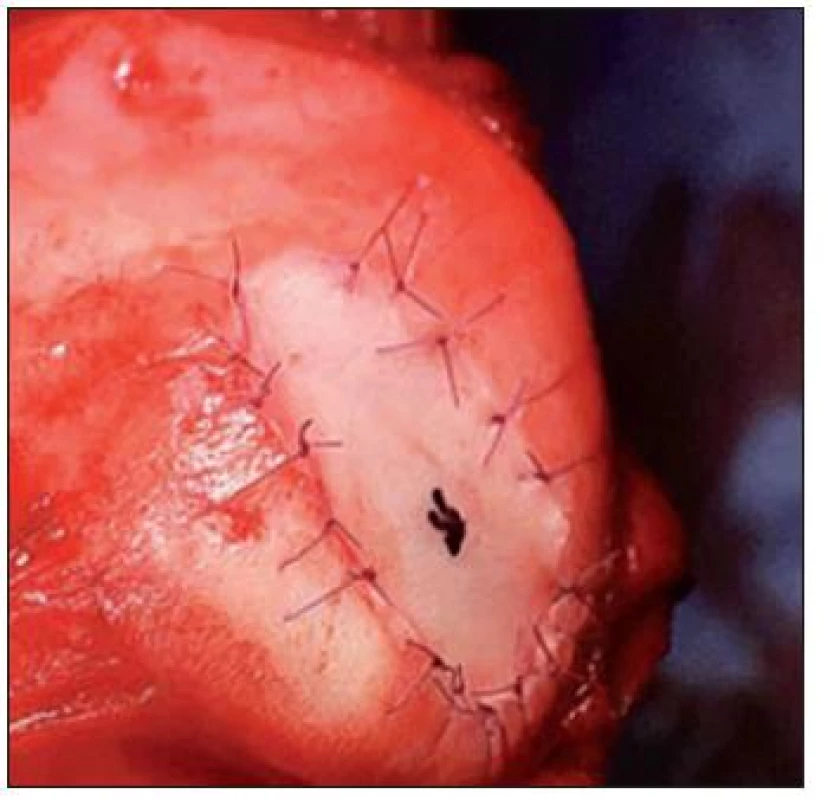 Implantácia autológnych chondrocytov – operačná technika, prekrytie defektu
