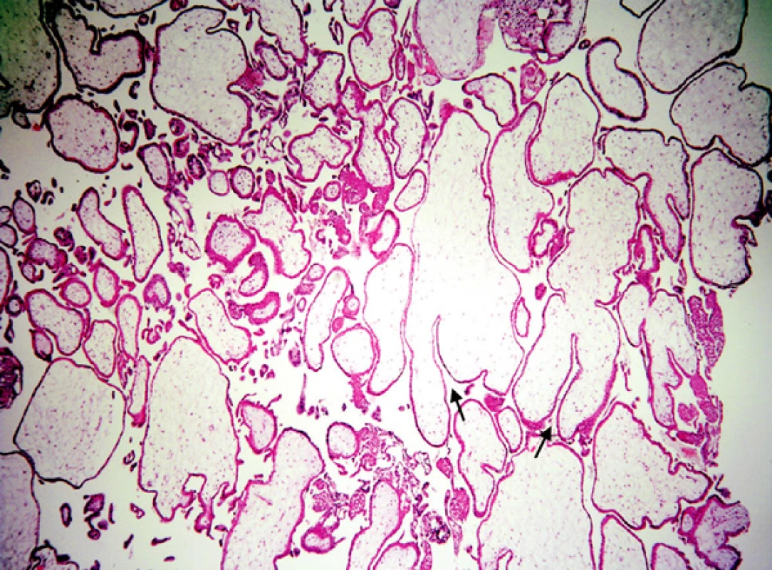 Mola hydatidosa partialis: hydropické i normální klky, lehká hyperplazie trofoblastu, hluboké, úzké „fjordovité“ invaginace (šipky)