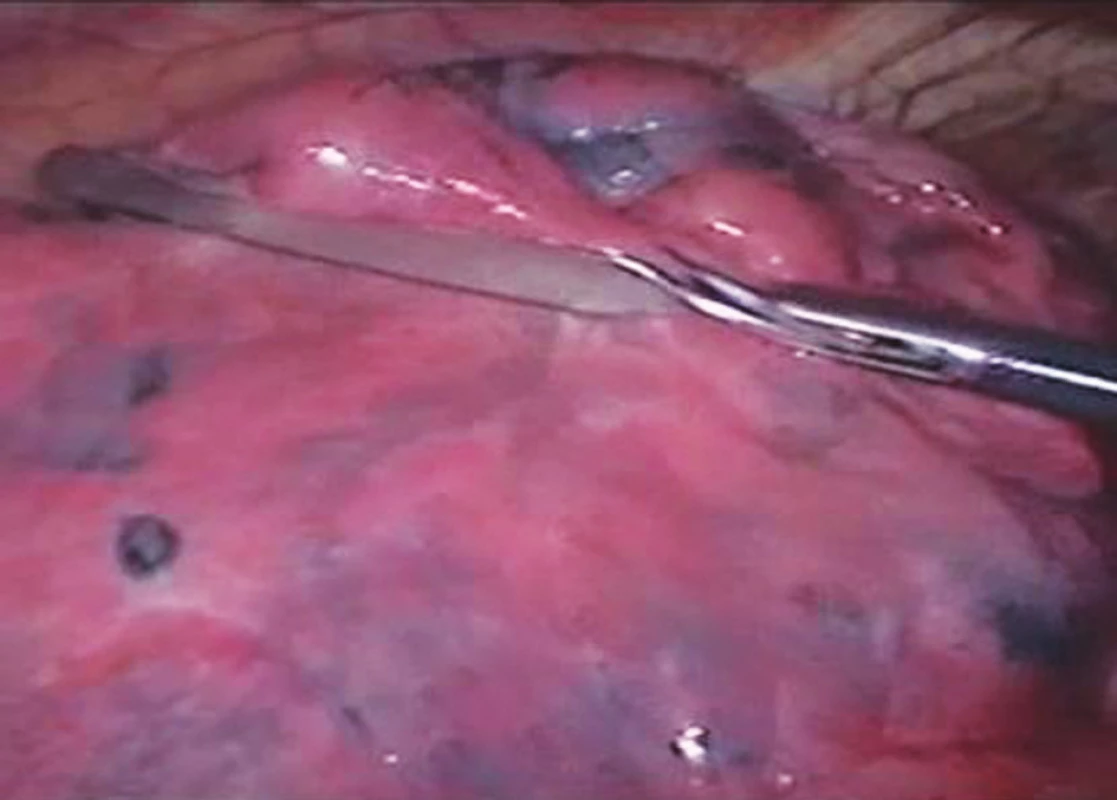 Vyšetření plicní tkáně atraumatickým grasprem
Pic. 1. Examination of pulmonary tissue using an atraumatic grasper