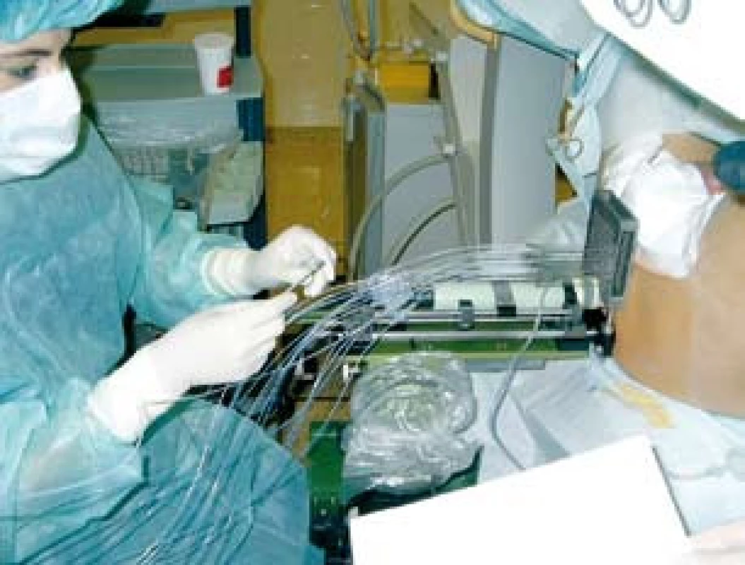 Transperineální aplikace jehel pod kontrolou transrektálního ultrazvuku
Fig. 1. Transperineal insertion of needles into prostate using ultrasound guidance