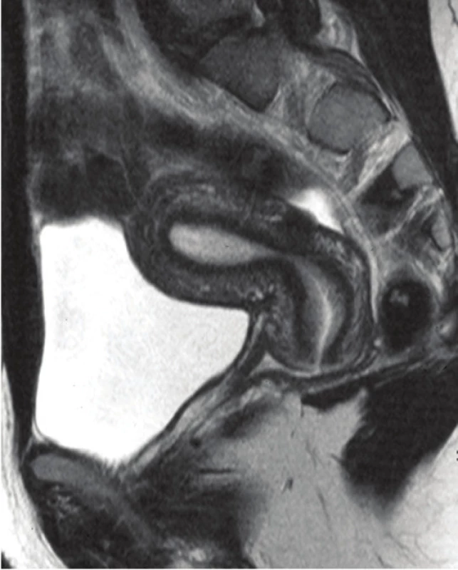 Intramurální myom v MRI obraze.