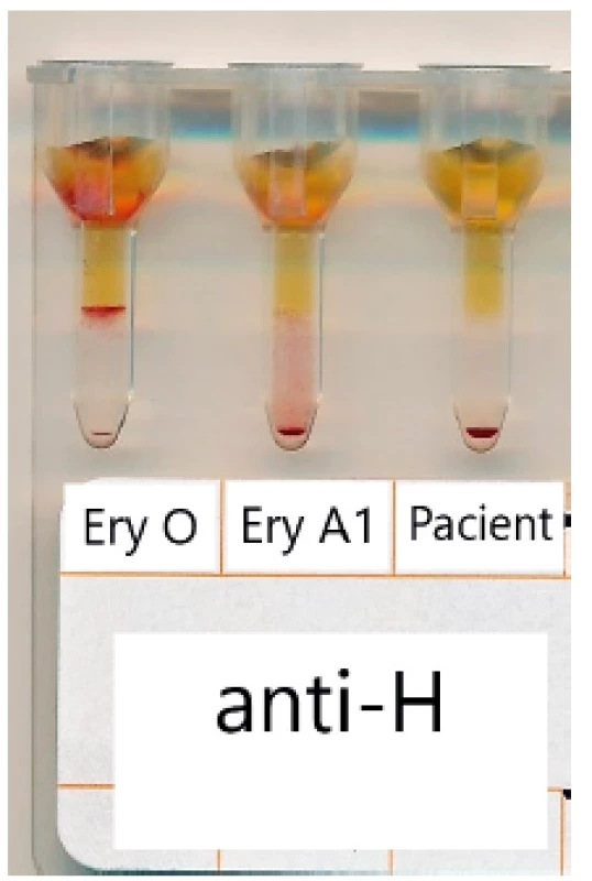 Typování antigenu H v gelové kartě BioRad