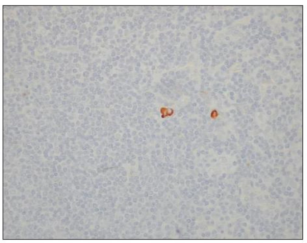 Izolované nádorové buňky v lymfatické uzlině u karcinomu žaludku (hnědě zbarvené buňky). Optická mikroskopie, zvětšení 400x, immunohistochemické barvení (směs protilátek proti buněčným cytokeratinům AE1/AE3). S laskavým svolením prof. MUDr. R. Kodeta, CSc., přednosty Ústavu patologie a molekulární medicíny 2. LF UK a FN Motol.
Fig. 3. Isolated tumor cells within a lymph node in a gastric carcinoma (brown stained cells). Optic microscopy, enlargement 400x, immunohistochemical staining (mixture of cytokeratin antibodies AE1/AE3). With kind approval by prof. MUDr. R. Kodet, CSc., Head of the Institute of Pathology and Molecular Medicine, 2nd Medical Faculty of the Charles University and Motol Faculty Hospital (LF UK and FN Motol)