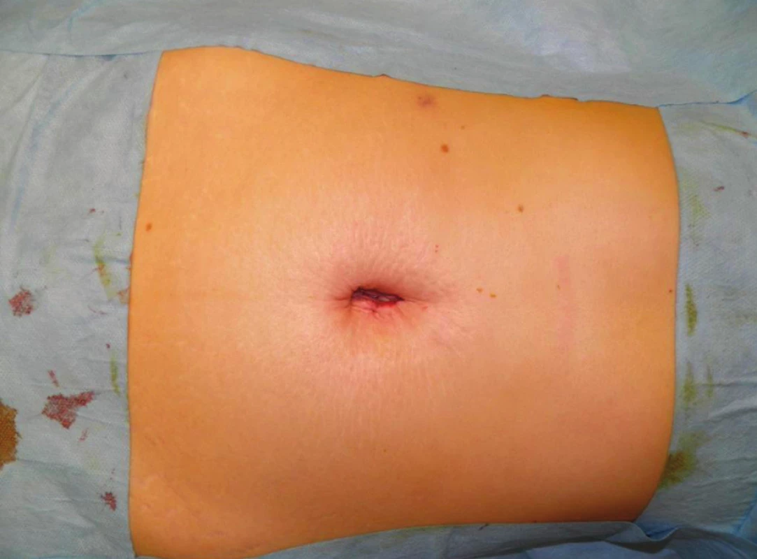 Suturovaná operačná ranka v oblasti umbilika
Fig. 3: The incision after suturing in the umbilicus area