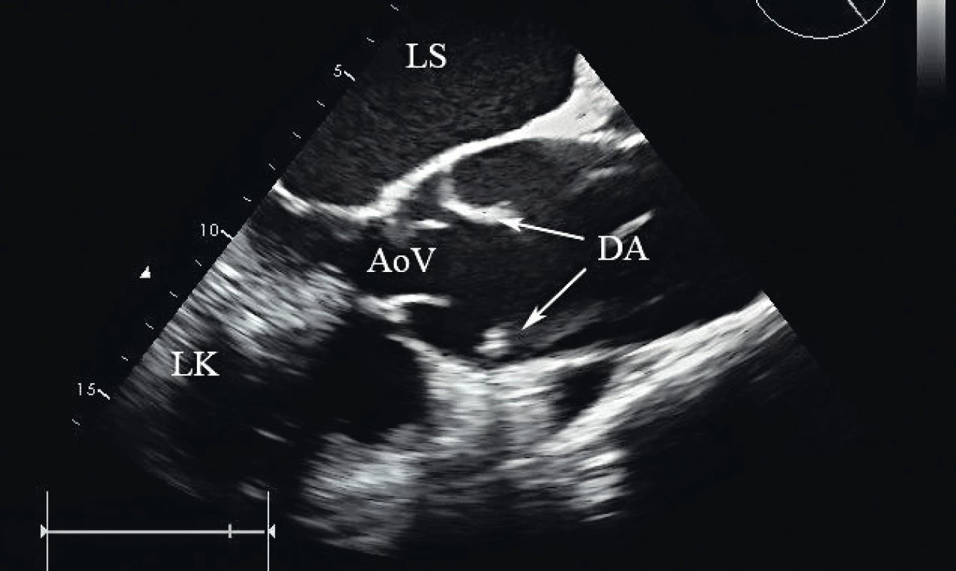 Disekce typu A v ascendentní aortě, dlouhá osa, TEE