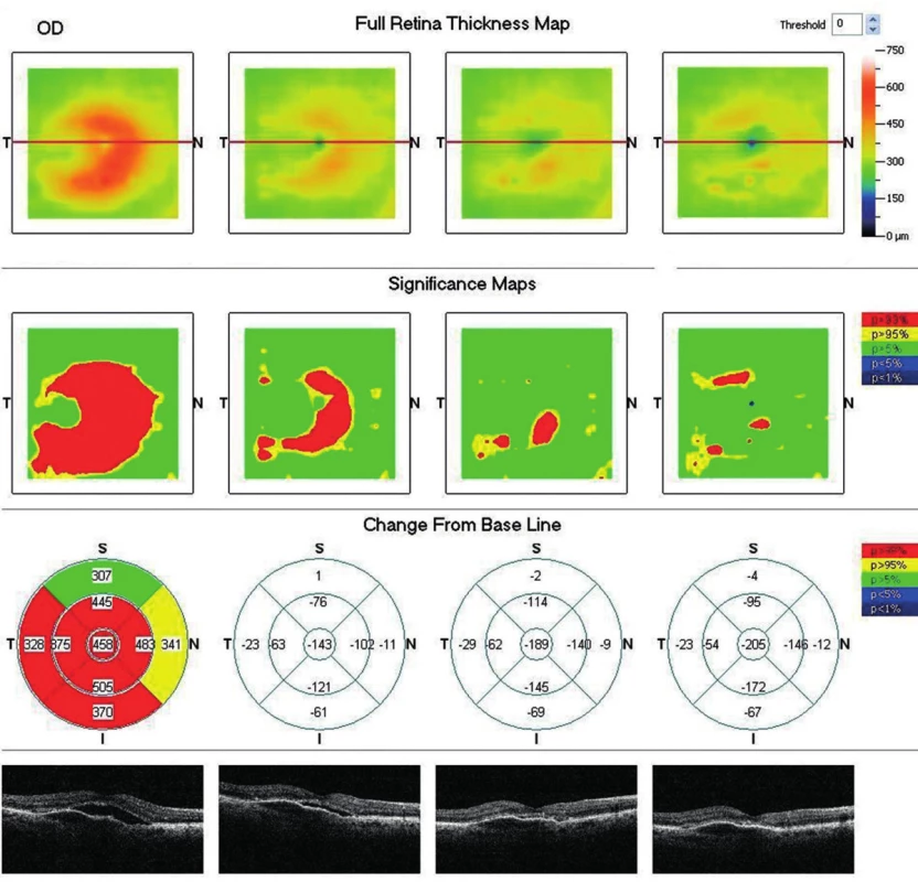 OCT snímok pravého oka (porovnávacia mapa po 10 mesiacoch od začatia liečby afliberceptom). Výrazná regresia edému aj seróznej ablácie neuroretiny. CHS -205μm. Ablácia RPE pretrváva