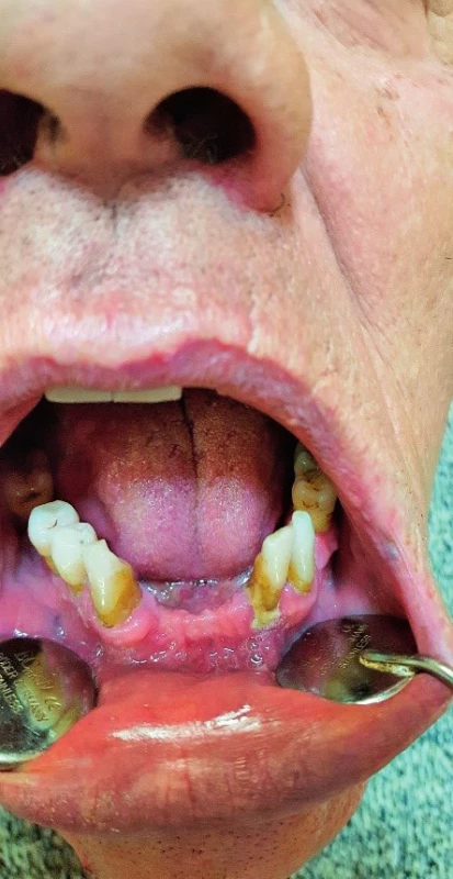 Parodontitída v sánke pred liečbou.