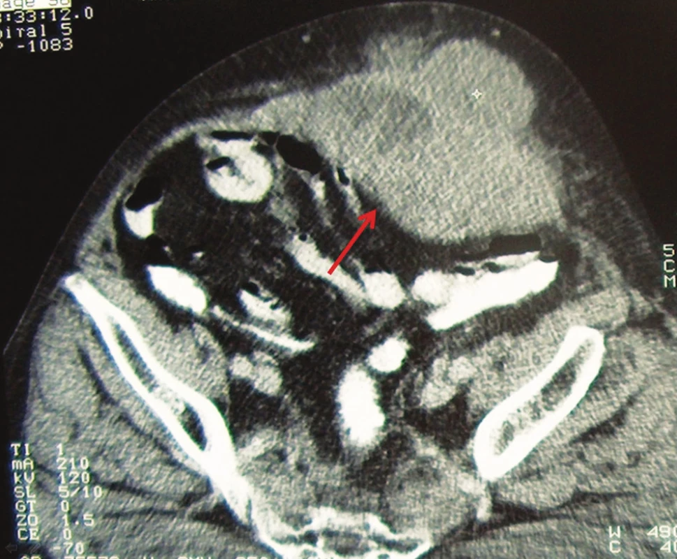 CT obraz metastázy adenokarcinómu do brušnej steny
Fig. 1. CT imaging of metastasis of adenocarcinoma into abdominal wall