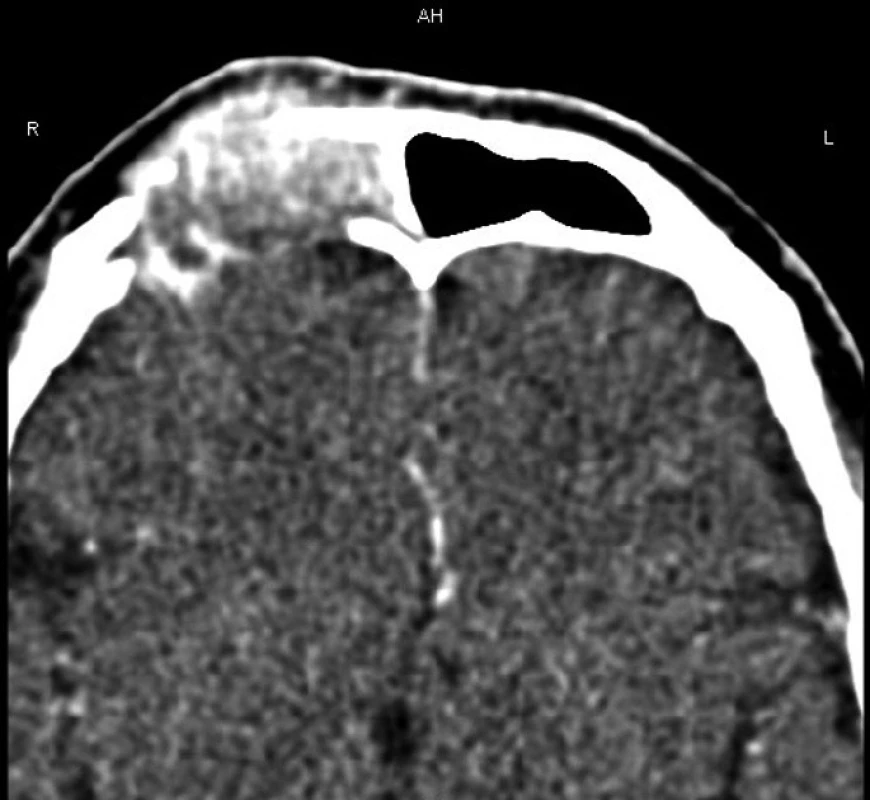 CT snímek: maligní nádor frontální dutiny – vpravo.