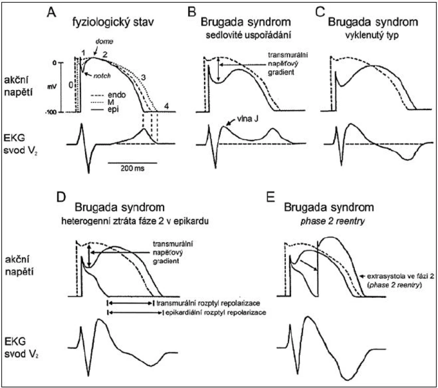 Změny konfigurace akčního napětí v epikardu pravé komory vysvětlující vznik typického uspořádání EKG křivky a arytmogenního substrátu u Brugada syndromu na základě tzv. repolarizační hypotézy. Vysvětlení v textu. 0 až 4 – fáze akčního napětí, endo – endokardiální srdeční buňky, M – srdeční buňky v tzv. M-oblasti, epi – epikardiální srdeční buňky. S dovolením převzato a upraveno z citace [29].