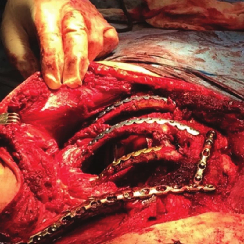 Peroperační nález
Fig. 11: Surgical procedure