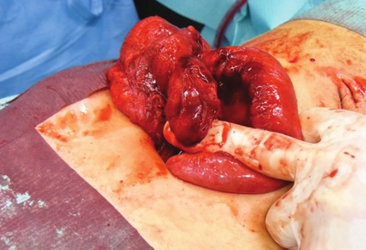 Enormně ztluštěný appendix budící dojem tumoru
Fig. 1: Enormously thickened appendix, giving an impression of being a tumour