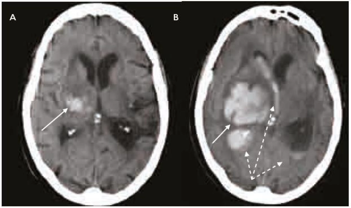 Intracerebrální krvácení u warfarinizovaného pacienta (INR 4,5).
a) Nevelké krvácení v centrálních strukturách pravé mozkové hemisféry (šipka). CT vyšetření 2 hod po příhodě.
b) Výrazná progrese velikosti hematomu (šipka) a provalení krve do komorového systému (přerušované šipky) v důsledku navozené perzistentní koagulopatie. Kontrolní CT vyšetření s odstupem 4 hod.
