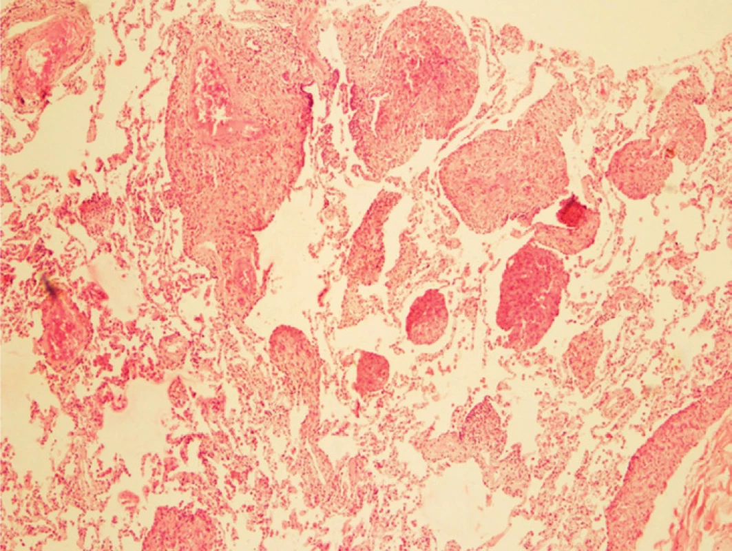 Histologický nález v přehledném zvětšení (40krát) zobrazující perivaskulární a peribronchiální histiocytární infiltráty v kolabované plicní tkáni