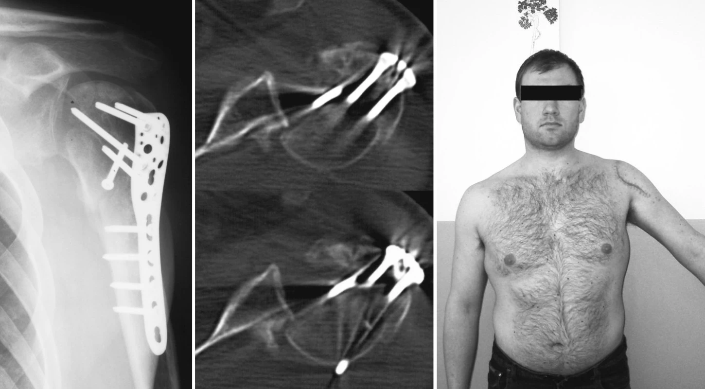 Nepoznaná zadní luxace po osteosyntéze kominutivní zlomeniny proximálního humeru – a) RTG snímek 3M po osteosyntéze, b) CT-nález zadní luxace, c) klinický nález
Pic. 4. Undiagnosed posterior dislocation following osteosynthesis of the proximal humerus comminutive fracture – a) a 3M x-ray view following osteosynthesis, b) a CT finding of posterior dislocation, c) a clinical finding