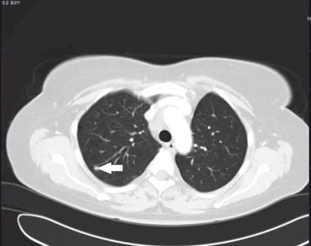 Bílá šipka – druhé metastatické ložisko v pravém horním laloku plic.
Fig. 4  White arrow – second colorectal cancer metastasis in right upper lung lobe.