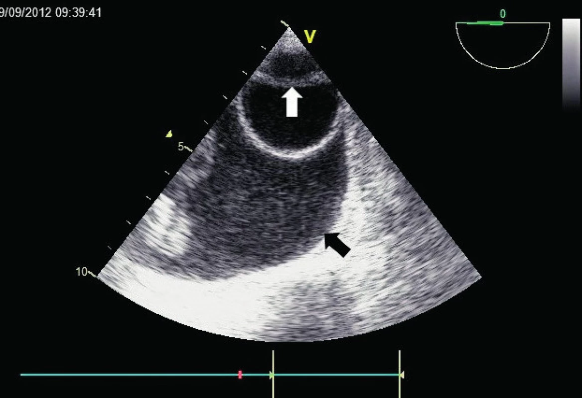 Descendentní aorta v krátké ose
TEE zobrazení sestupné aorty s patrným intimálním flapem (bílá šipka), dělícím její lumen na pravé a falešné. Současně je zřetelný významný levostranný pleurální výpotek (černá šipka).