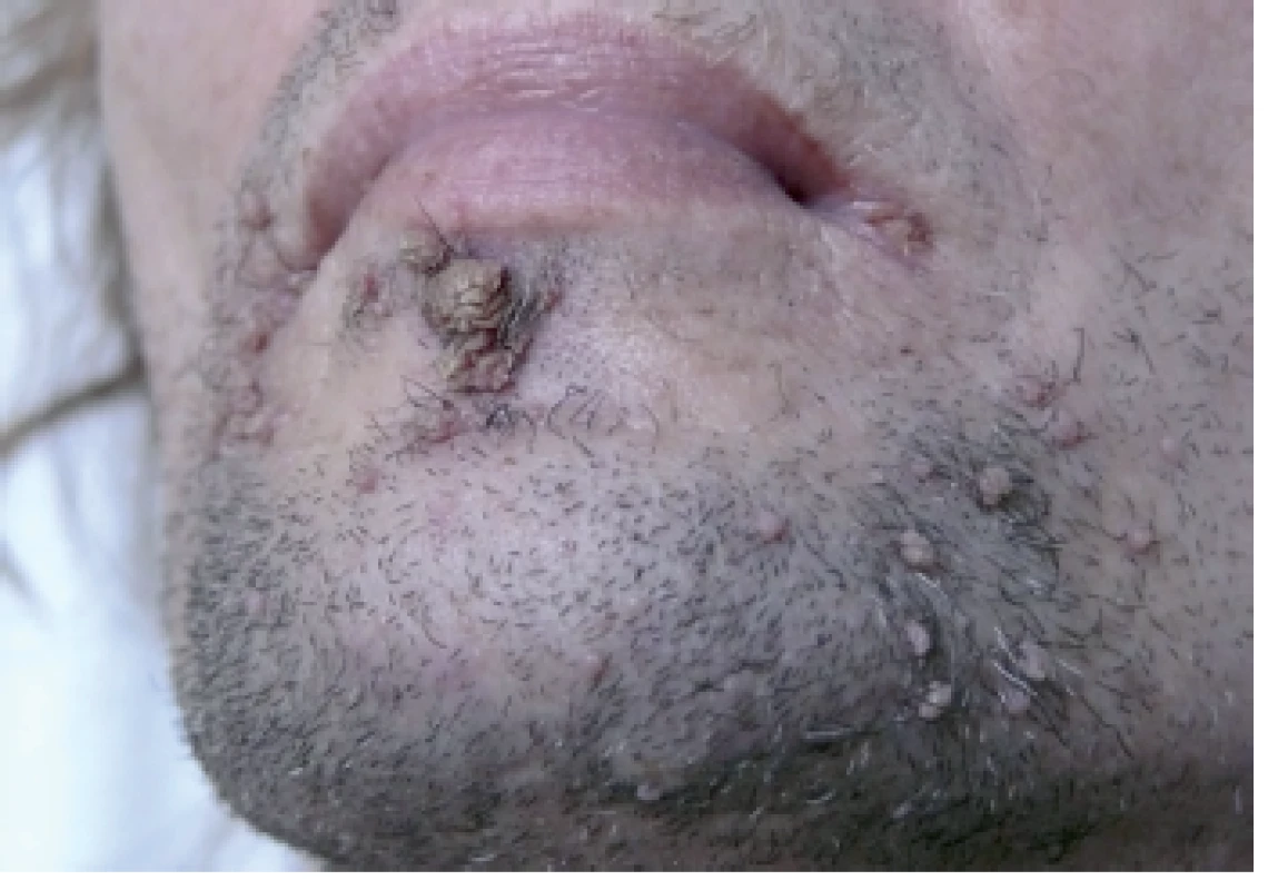 Verrucae vulgares u HIV pozitívneho pacienta na brade a v periorálnej oblasti