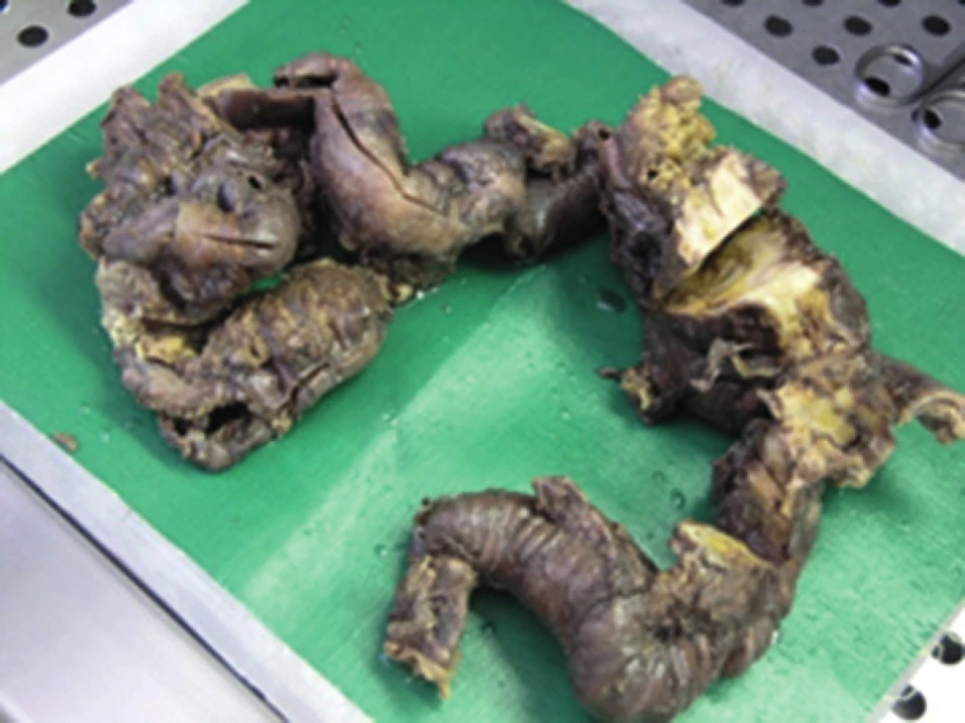 Makroskopické pitevné nálezy poukazujú na rozsah a hrúbku osifikácie zostávajúcej časti čreva
Fig. 6: Macroscopic autopsy findings indicate the extent and thickness of ossification of the residual part of the intestine