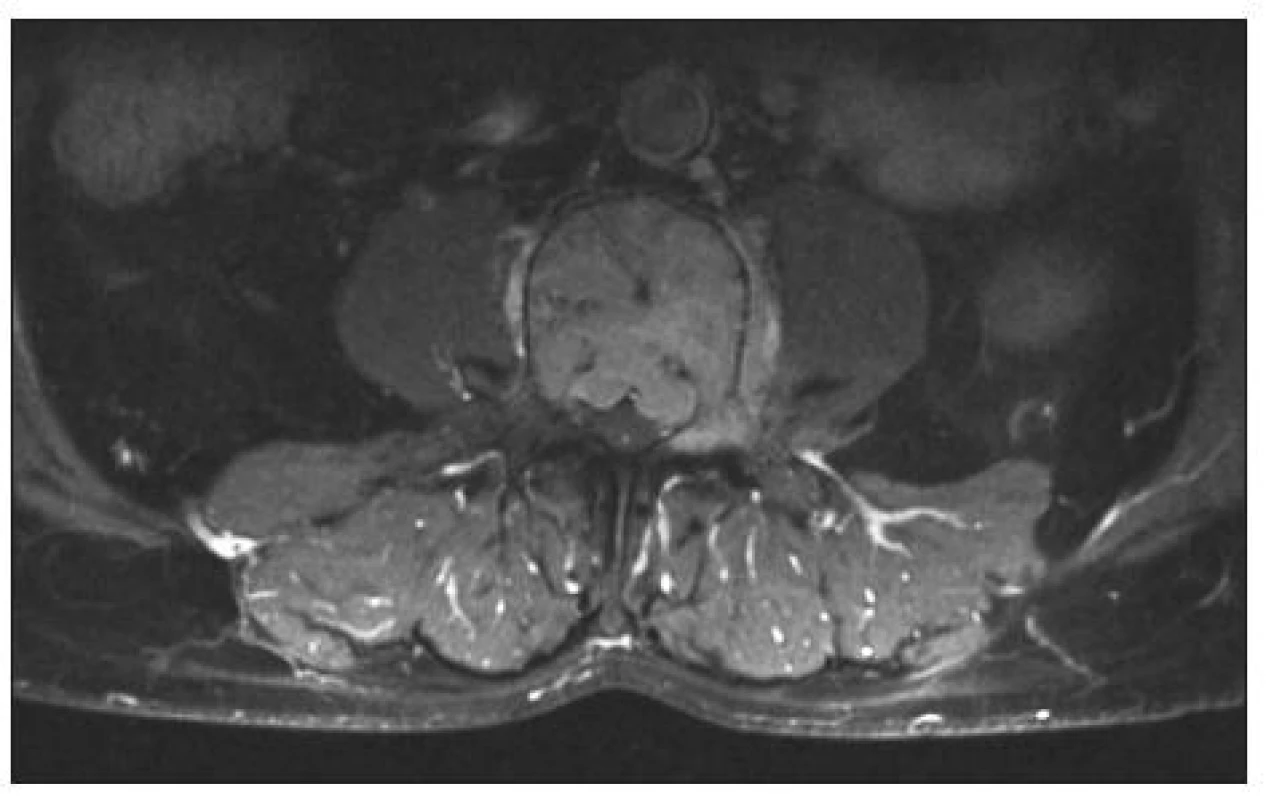 MR lumbosakrální páteře, axiální sken, T2 zobrazení. Propagace tumoru do kanálu páteřního a paravertebrálně,
obratel L3
Fig. 2. MRI, lumbosacral spine, axial view, T2 imaging. Paravertebral spread of the tumor and its spread into the spinal canal, L3 level