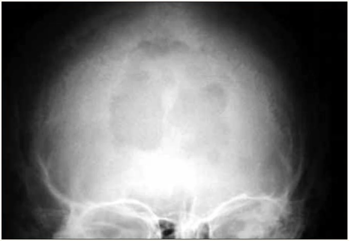 Osteolytické ložisko lebky na předozadním RTG snímku.