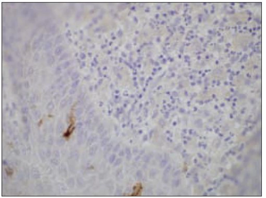 Kožný histiocytóm, negatívny dôkaz CD1a, ojedinelé intradermálne Lanhergansove bunky sú CD1a+ (40krát).