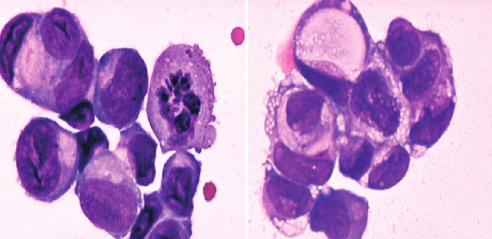 a) Shluk velkých epiteliálních nádorových buněk v mozkomíšním moku (barvení May-Grünwald-Giemsa). b) Shluk nádorových buněk v mozkomíšním moku s vakuolizací cytoplazmy (tzv. buňky tvaru pečetního prstenu)  iagnostické pro adenokarcinom (archiv autora).