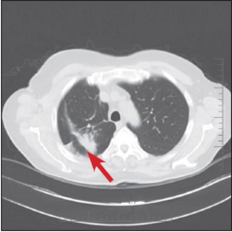 CT plic v březnu 2013. Je vidět mírná regrese ložiska.