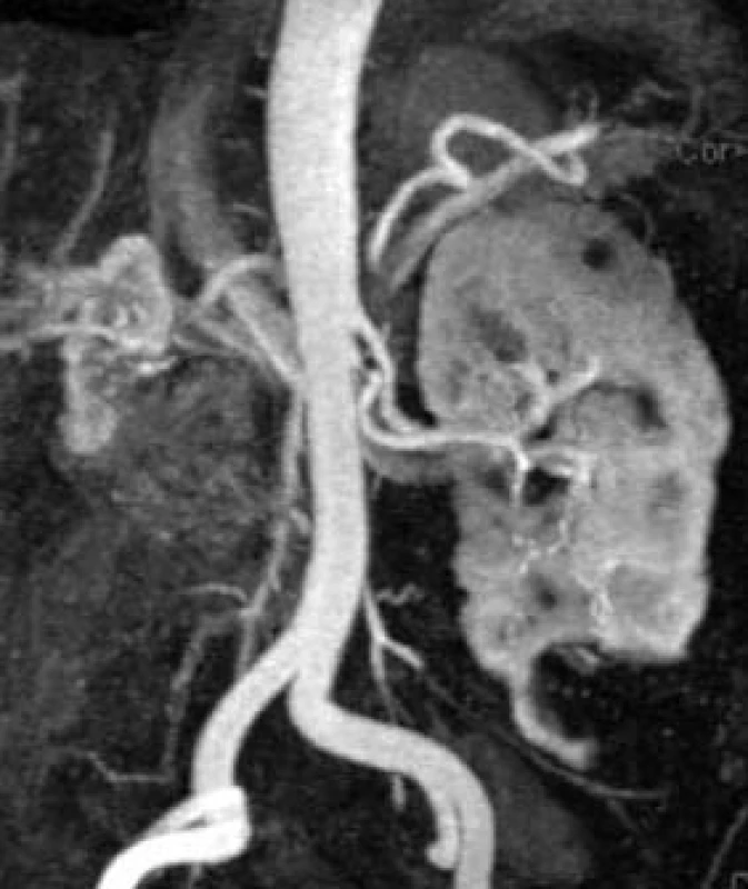 MR-angiografie ledvin: hyploplazie pravé ledviny, levá ledvina je naopak kompenzatorně větší. Nehomogenita sycení parenchymu ledvin je způsobeno přítomností mnohočetných cyst při polycystóze. Vlevo je patrné zdvojení ledvinné tepny a významná koncentrická stenóza jedné z nich.