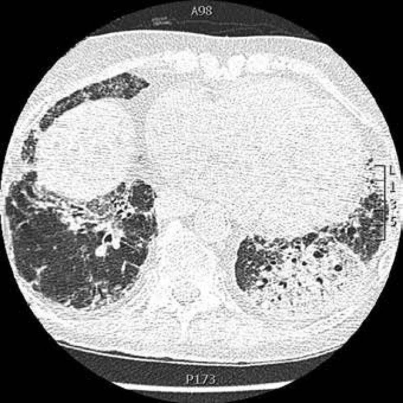 CT hrudníku: pneumonie vlevo