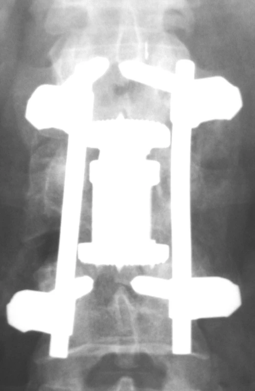 Implantovaný koš Synex, předozadní projekce
Pic. 3. Implanted Synex cage, AP view