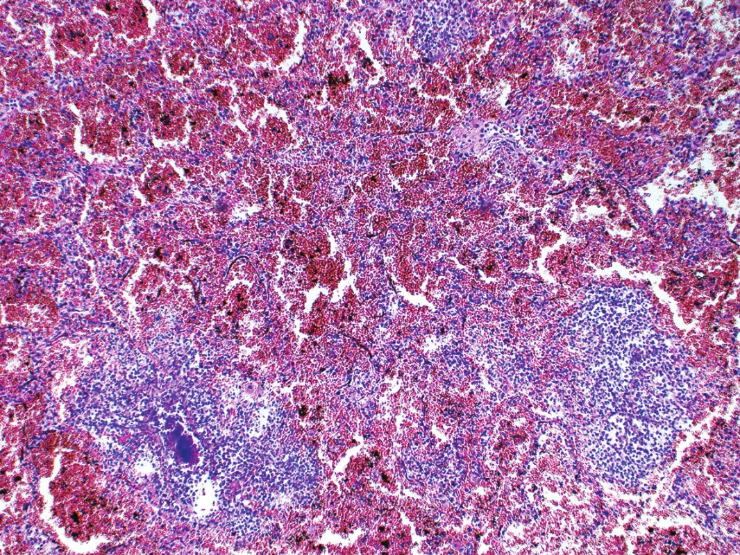 Histologický obraz abscedující hemoragické pneumonie s koloniemi bakterií (HE, 40x) .