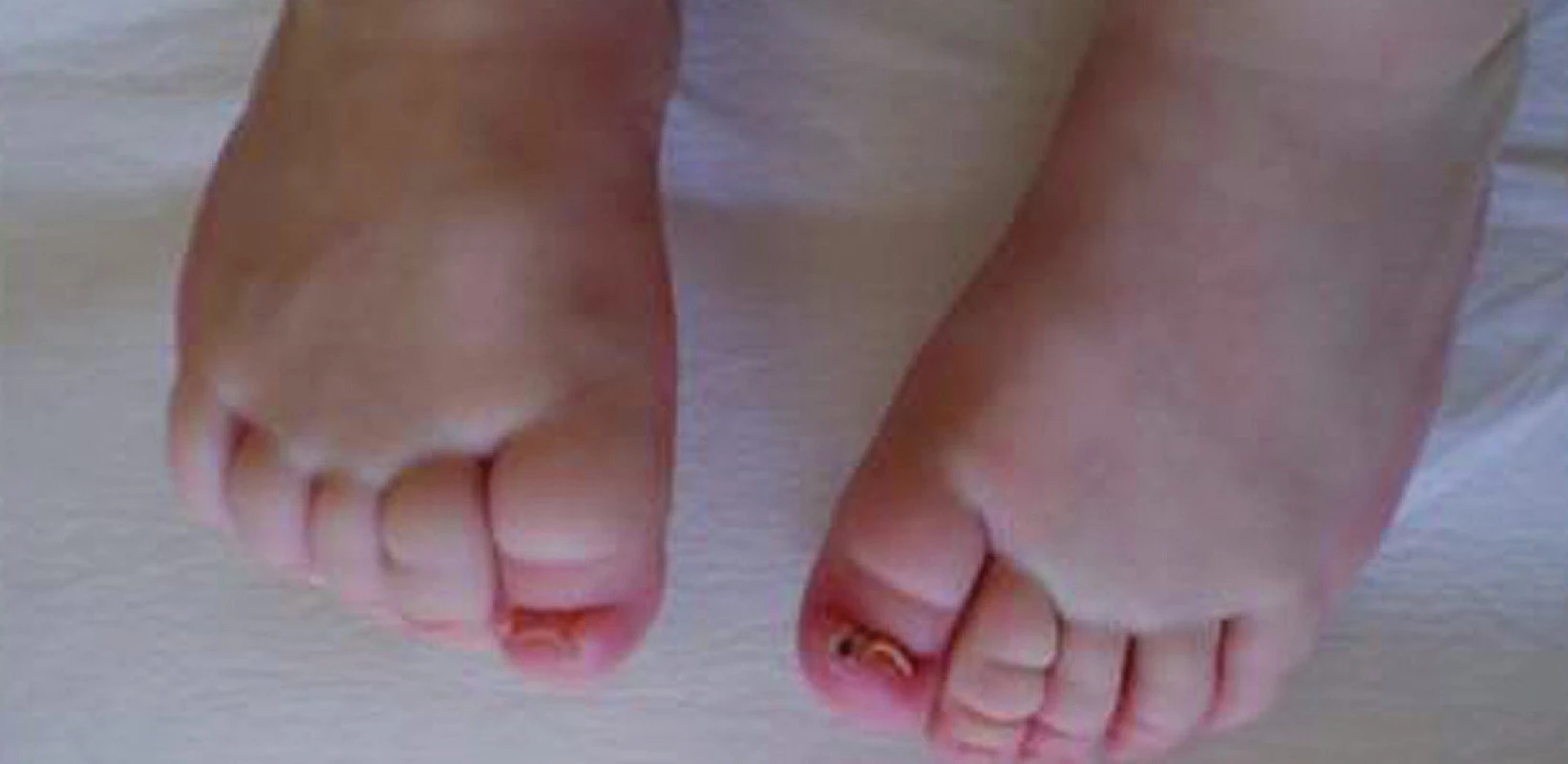 „Miskovité“ nehty na nohou u ročního děvčátka s Turnerovým syndromem, které jsou příčinou častých panaritií.
