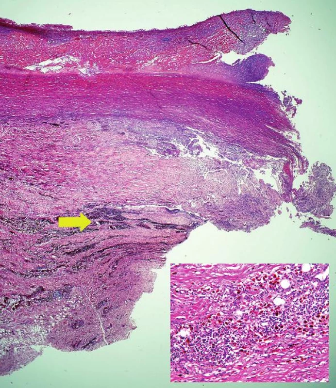 Okraj perforácie aorty s nekrózou steny s masívnymi depozitmi plazmatických buniek 
a siderofágov v priľahlej adventícii (šípka + vložený obrázok) (hematoxylín-eozín, zväčšenie 20x).